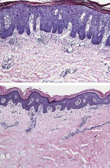 건선 피부의 두꺼운 표피(상)-항체 처치 8주 후 정상 수분의 피부(하).©Laboratory of Investigative Dermatology at Rockefeller University/Journal of Allergy and Clinical Immunology