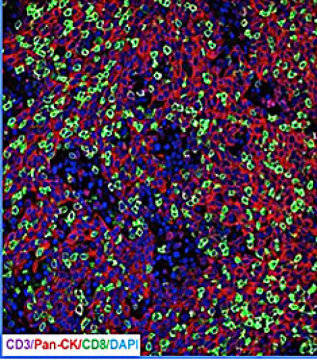 Pembrolizumab.ⒸImage courtesy of University of Chicago Medical Center