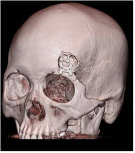 눈썹절개 개두술 환자의 CT 사진, 두개골 절개의 크기가 2-3 cm로 매우 작음을 볼 수 있다.