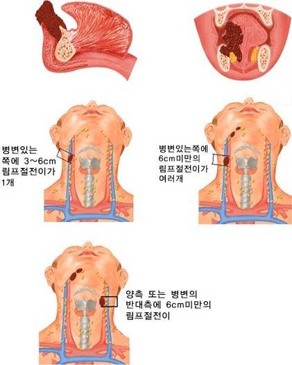 구강암4기(암이 뼈나 얼굴의 피부, 혀의 심부근육을 침범했거나 원발부위쪽에 3~6cm의 림프절 전이가 1개 있는 경우 목에 6cm 이하의 림프절 전이가 2개이상 있거나 양측 또는 병변의 반대측 림프절에도 전이된 경우로 원격전이는 없는 경우) ;국가암정보센터