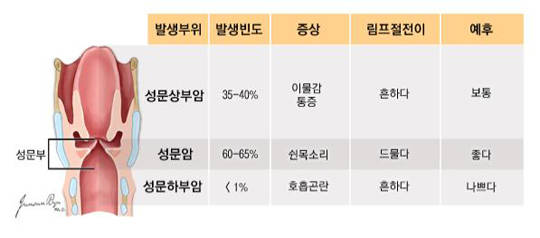 후두암의 발생부위에 따른 분류;국가암정보센터