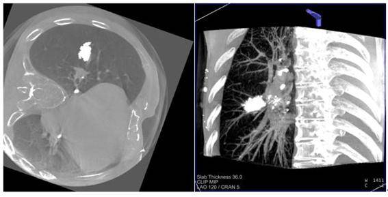 2세대 로봇 C-Arm & cone beam CT(Artis ZeegoQ, Simens, USA)시스템으로 촬영된 3차원영상