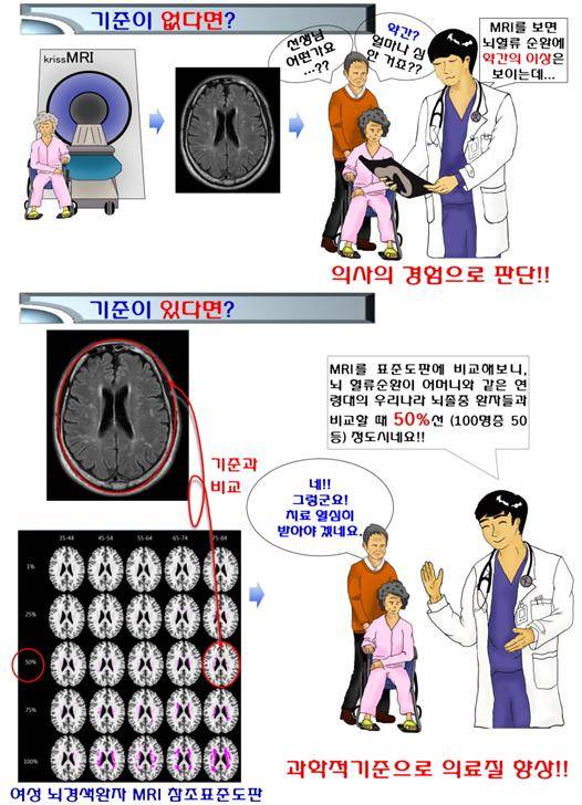 한국인 허혈 뇌지도 활용 사례