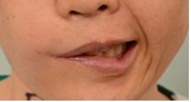 (수술 전) 입이 돌아가는 안면신경마비환자로 남 앞에서 잘 웃지 못하고 손으로 입을 가리게 된다.