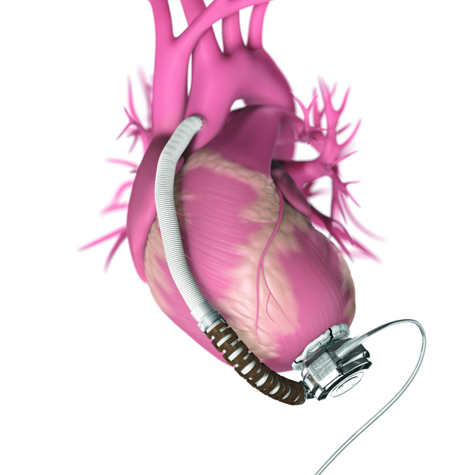 최지선 양에게 이식된 체내형 LVAD.
