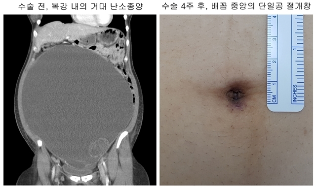 거대 난소종양 수술 전후 사진