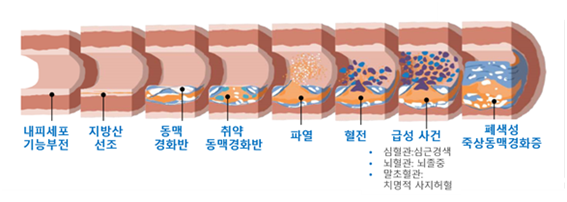 LDL-C 축적에 따른 죽상경화증 진행과정