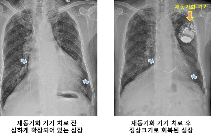 심장재동기화 사진