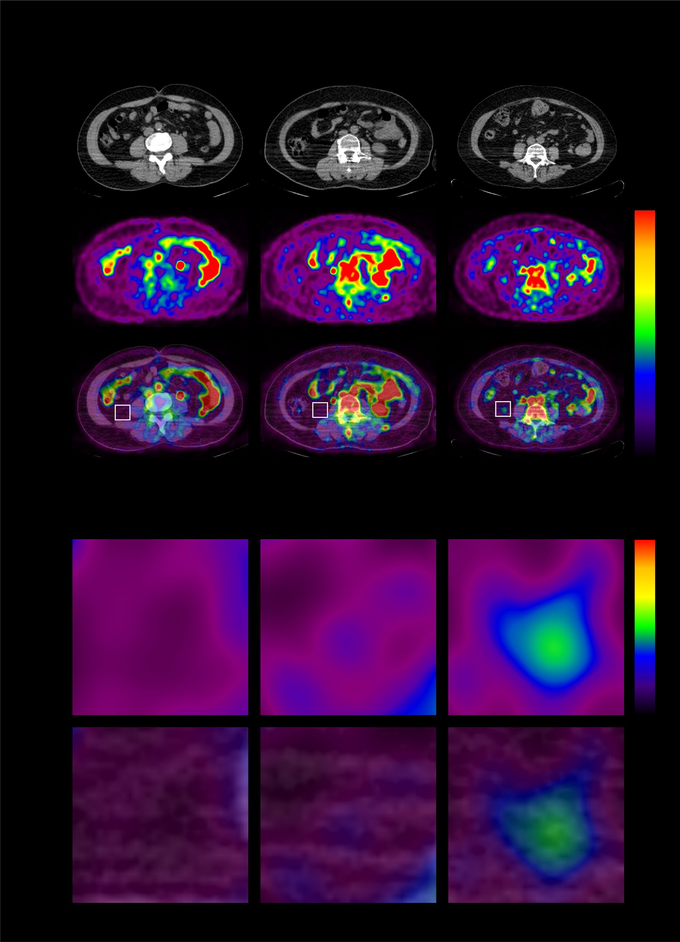 Fig. 1 Representative images of visceral adipose tissue (VAT) glucose uptake according to the severity of coronary artery disease (CAD) (a), and their corresponding magnified views (b). CSA chronic stable angina, AMI acute myocardial infarction, CT computed tomography, PET positron emission tomography