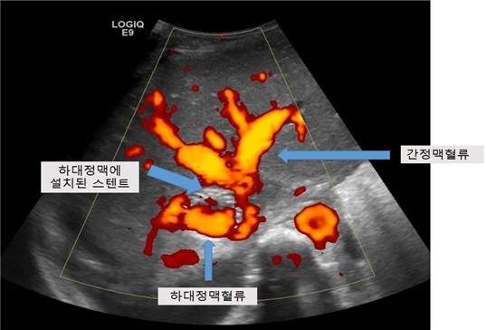 그림 3 : 간초음파를 통하여 간정맥에서 하대정맥에 설치한 스텐트 내로 혈류가 원활히 유입되는 모습